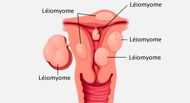 Lire la suite à propos de l’article Myome de l’utérus