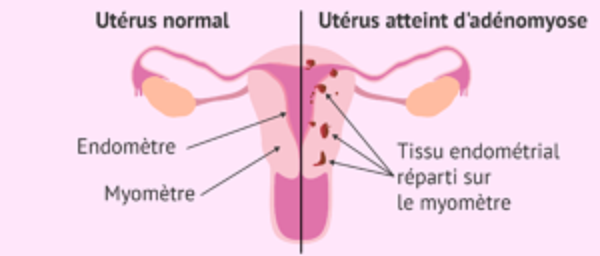Lire la suite à propos de l’article l’endométriose, maladie chronique touchant 1 femme sur 10.