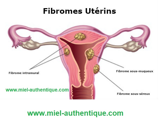 You are currently viewing Les fibromes